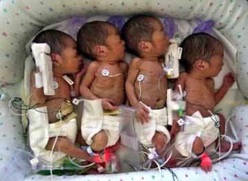 Ομοζυγωτικά τετράδυμα απέκτησε νεαρή Ινδή