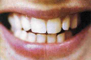 Συσκευή υπερήχων αναγεννά σπασμένα δόντια