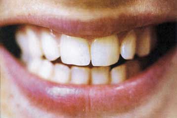 Συσκευή υπερήχων αναγεννά σπασμένα δόντια