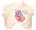 Μυοκαρδιοπάθεια: Ανταγωνισμός καρδιάς-πνευμόνων για θωρακικό χώρο
