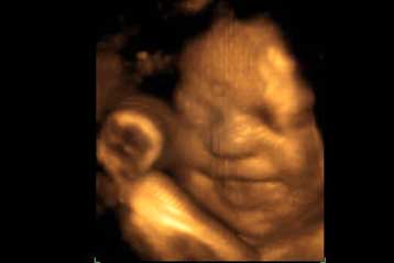 Τα υπερηχογραφήματα ίσως επηρεάζουν τα αναπτυσσόμενα έμβρυα