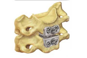 Αποτελεσματικός κρίνεται ο πρώτος τεχνητός μεσοσπονδύλιος δίσκος