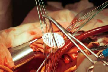 Ανθρώπινες καρδιακές βαλβίδες δημιουργήθηκαν από εμβρυικά κύτταρα