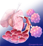 Aφιέρωμα στην Κυστική Ίνωση: Γνωρίστε την πιο συχνή κληρονομική νόσο