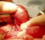 Η μεταμόσχευση νεφρού τριπλασιάζει τον κίνδυνο καρκίνου