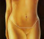 Κοιλιοπλαστική