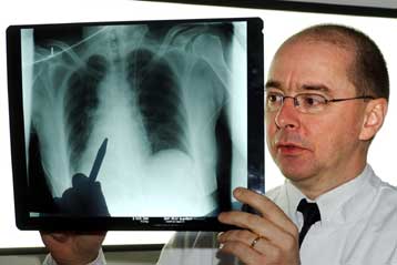 Εμβόλιο κατά του καρκίνου του πνεύμονα στα τελικά στάδια των δοκιμών