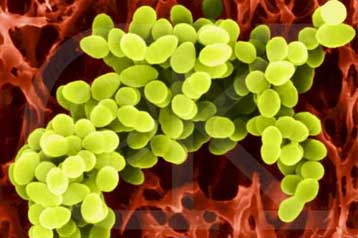 Νέο στέλεχος σταφυλόκοκκου προκαλεί θανατηφόρο πνευμονία