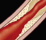 Η υπέρταση κύησης αυξάνει τον κίνδυνο στεφανιαίας αποτιτάνωσης μετέπειτα