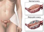 Από πολυκυστικές ωοθήκες πάσχει το 5% έως 10% των γυναικών