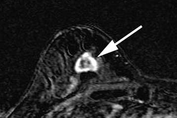 Νέα εργαλεία για την έγκαιρη διάγνωση του καρκίνου του μαστού