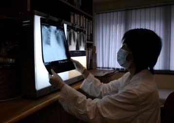 Τα μέτρα κατά της φυματίωσης «ατονούν στην Ελλάδα»