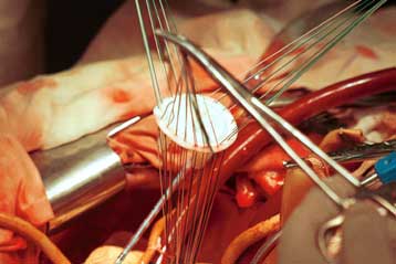 Καρδιακές βαλβίδες από βλαστικά κύτταρα καλλιεργεί ο Μαγκντί Γιακούμπ