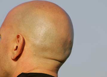 Νέος τρόπος αναγέννησης των μαλλιών δίνει ελπίδες στους φαλακρούς