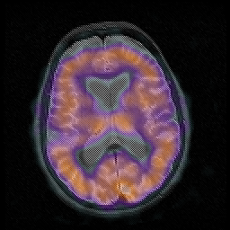 Νέα στοιχεία για τη νόσο Huntington