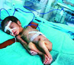 Τα πολύ πρόωρα νεογνά αντιμετωπίζουν προβλήματα κατά την σχολική ηλικία