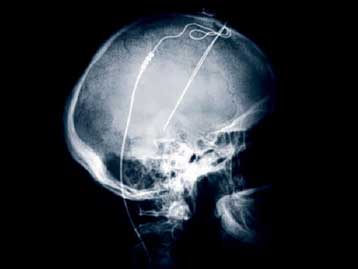 Τα ηλεκτρόδια «ανέστησαν» έναν ασθενή που βρισκόταν επί έξι χρόνια σε κώμα