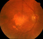 Ισχυρό γενετικό υπόβαθρο έχει η εκφύλιση της ωχράς κηλίδας