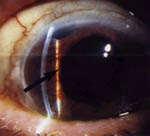 Πιθανή η απώλεια της κεντρικής όρασης μετά την χειρουργική αντιμετώπιση του γλαυκώματος