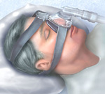 Η θεραπεία της άπνοιας ύπνου συντελεί σε μείωση και του καρδιακού κινδύνου