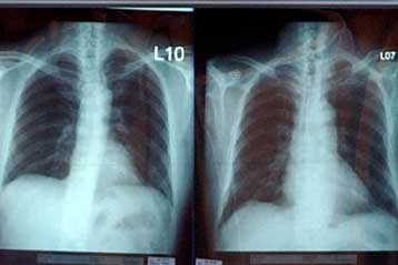 Πληθώρα γενετικών βλαβών ανιχνεύεται στον καρκίνο του πνεύμονα