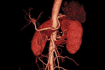 Αξονικοί τομογράφοι νέας γενιάς αυξάνουν την ανάλυση, μειώνουν την ακτινοβολία