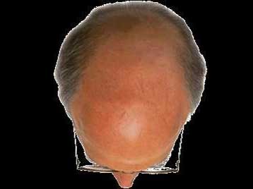 Αυξημένος κίνδυνος φαλάκρας για τους θεριακλήδες, υποδεικνύει νέα μελέτη