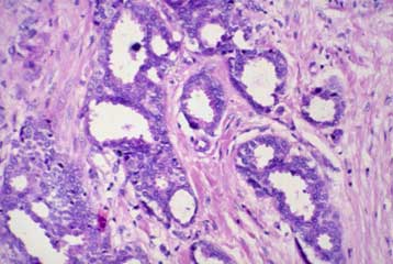 Εντοπίστηκε γονίδιο που προκαλεί μετάσταση του καρκίνου του μαστού