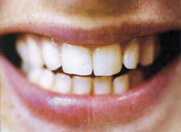 Πειραματική καραμέλα συνδράμει στον πόλεμο κατά της τερηδόνας