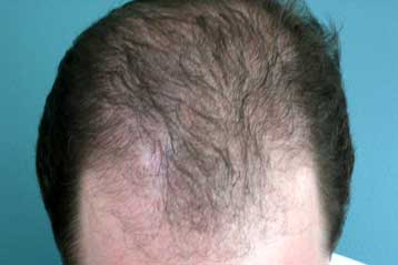 Τρίχες του σωλήνα για την αντιμετώπιση της φαλάκρας