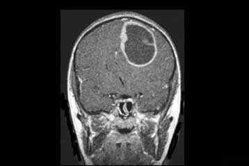 Εμβόλιο προσφέρει ελπίδα κατά του συνηθέστερου καρκίνου του εγκεφάλου