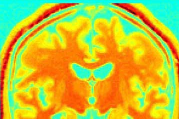 Ο εγκέφαλος των ομοφυλόφιλων «μοιάζει με τον εγκέφαλο του αντίθετου φύλου»