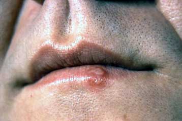 Ανοίγει ο δρόμος για πλήρη ίαση του έρπητα