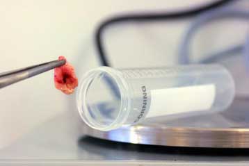 Νέα μορφή σπογγώδους εγκεφαλοπάθειας αναγνωρίστηκε στις ΗΠΑ