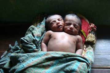 Βρέφος με δύο κεφάλια πέθανε λίγο μετά τη γέννησή του στο Μπανγκλαντές