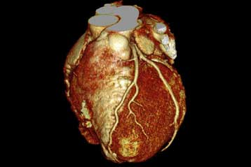 Νέο μόριο υπόσχεται καλύτερες θεραπείες για το έμφραγμα