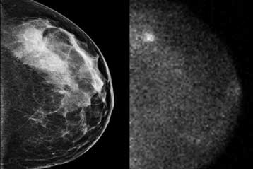 Πειραματικό εμβόλιο ελπιδοφόρο κατά του καρκίνου του μαστού