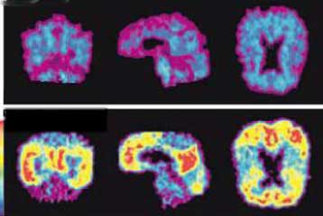 «Εντός πέντε ετών» το εμβόλιο για την αντιμετώπιση της Αλτσχάιμερ