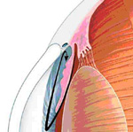 Γλαύκωμα: στοχεύοντας εκλεκτικά στη ρίζα του προβλήματος