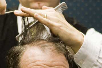 Κυνηγοί γονιδίων λύνουν το μυστήριο της φαλάκρας