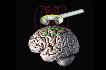 Μαγνητική τεχνική κατά της κατάθλιψης εγκρίθηκε στις ΗΠΑ
