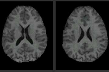 Νέα θεραπεία δίνει «θεαματικά» αποτελέσματα κατά της πολλαπλής σκλήρυνσης