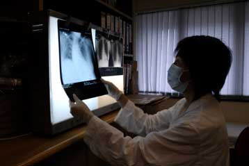 Γενετικές ποικιλομορφίες αυξάνουν κατά 60% το ρίσκο για καρκίνο του πνεύμονα