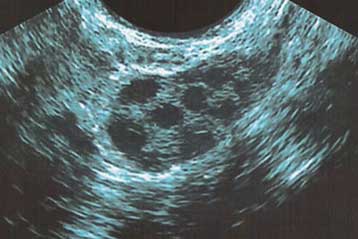 Πρώτη γέννηση από ολόκληρη μεταμοσχευμένη ωοθήκη