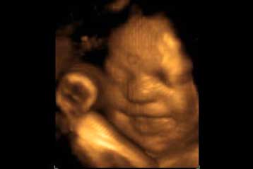 Τα υψηλά επίπεδα τεστοστερόνης στη μήτρα «δημιουργούν τάσεις αυτισμού»