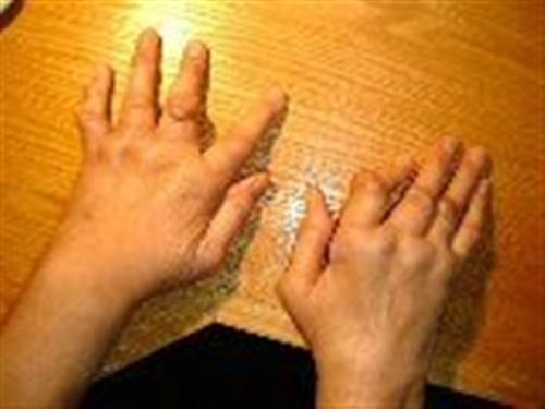 Εντονότερη η ρευματοειδής αρθρίτιδα για τις γυναίκες