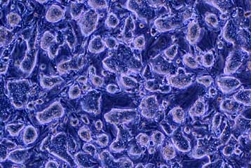 Βλαστικά κύτταρα για την τύφλωση και το εγκεφαλικό θα δοκιμαστούν στη Βρετανία