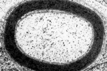 Βλαστικά κύτταρα αναστρέφουν την πορεία της σκλήρυνσης κατά πλάκας