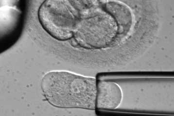 Mωρό που ελέχθηκε για καρκινογόνο γονίδιο γεννήθηκε για πρώτη φορά στη Βρετανία