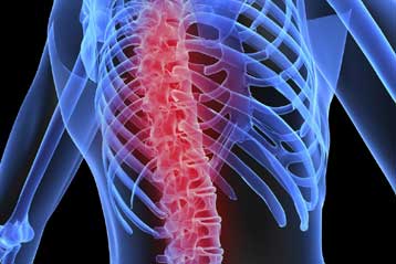 Η οστεοπόρωση πλήττει συχνά και τους άνδρες